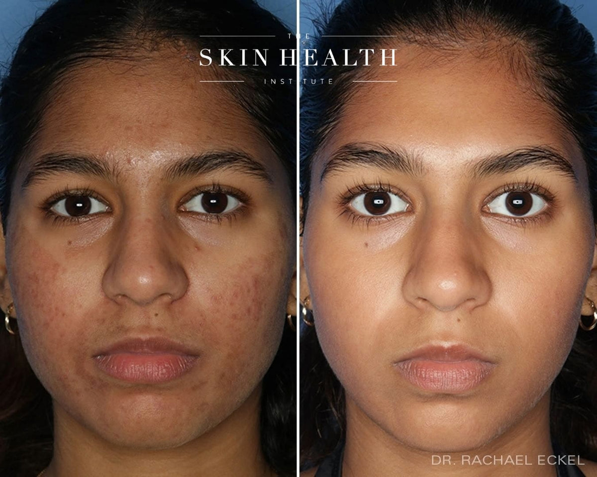 Before and After Results