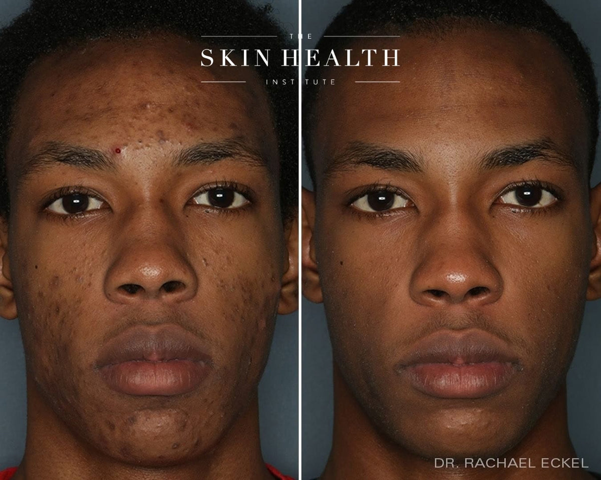 Before and After Results