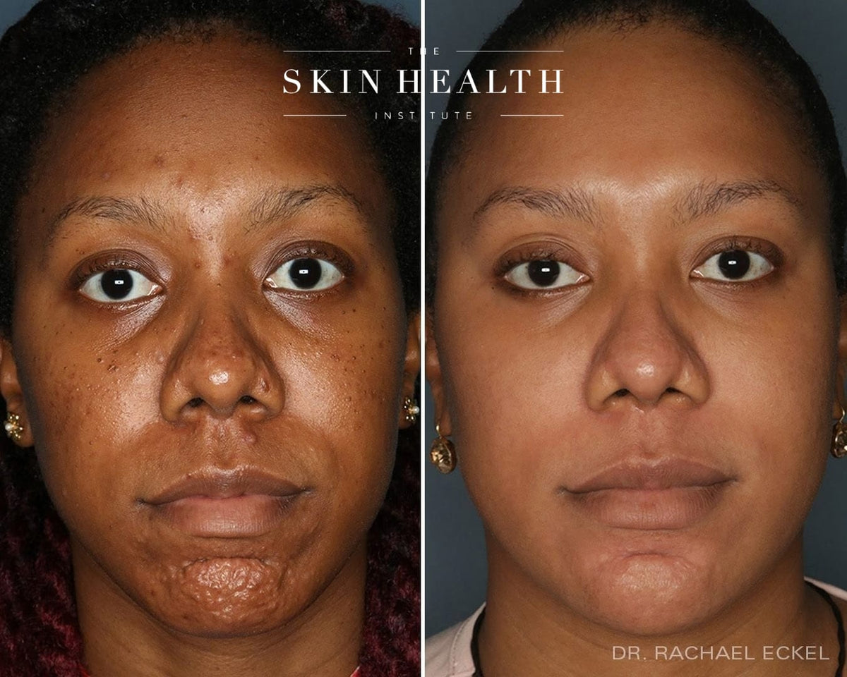 Before and After Results