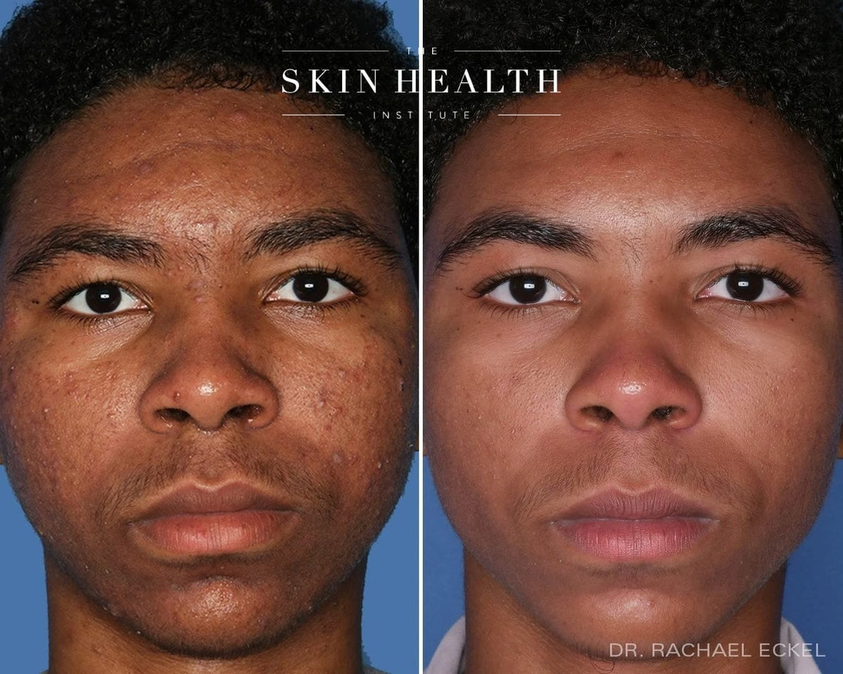 Before and After Results