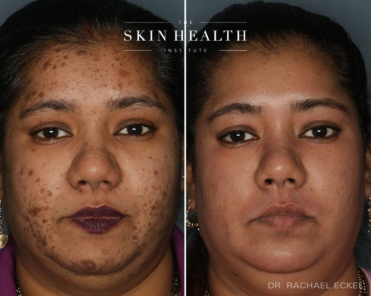 Before and After Results