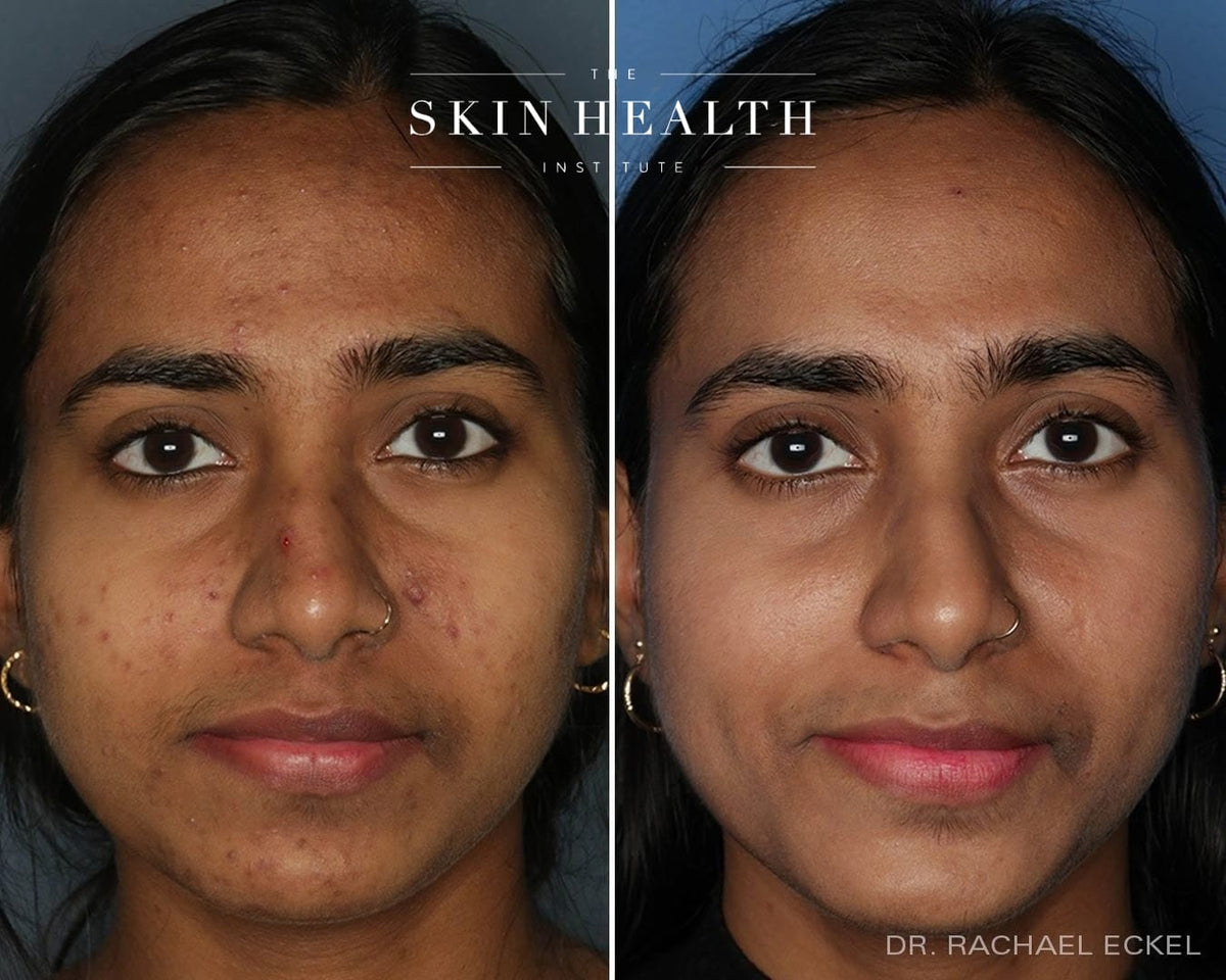 Before and After Results