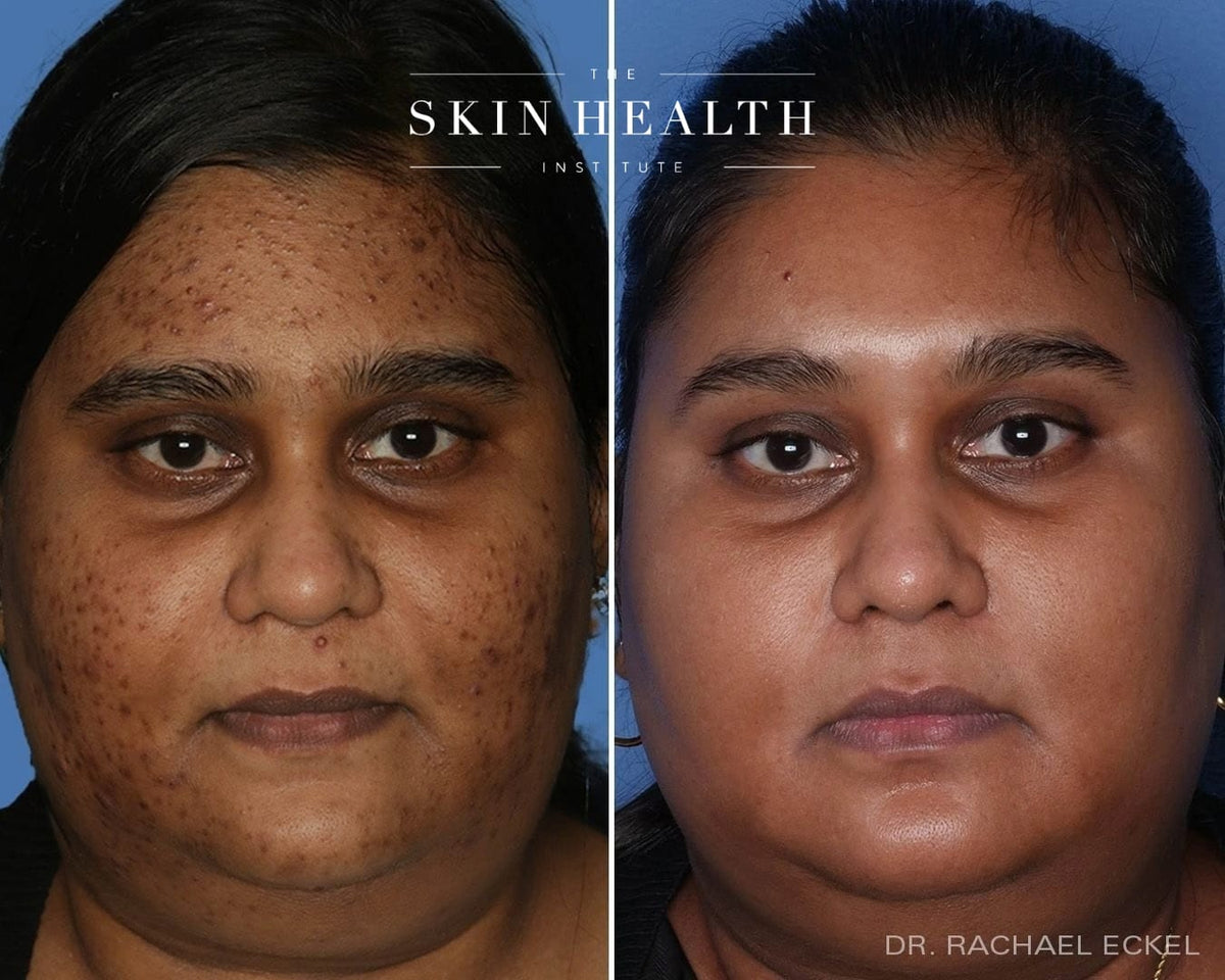 Before and After Results