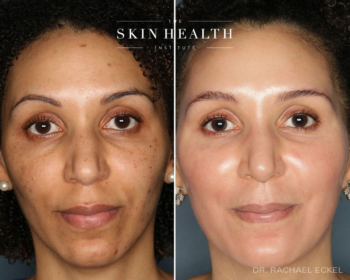 Before and After Results