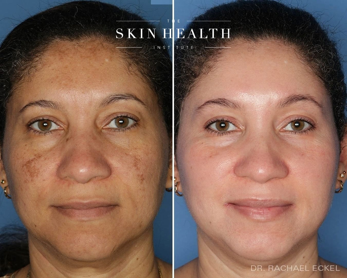 Before and After Results