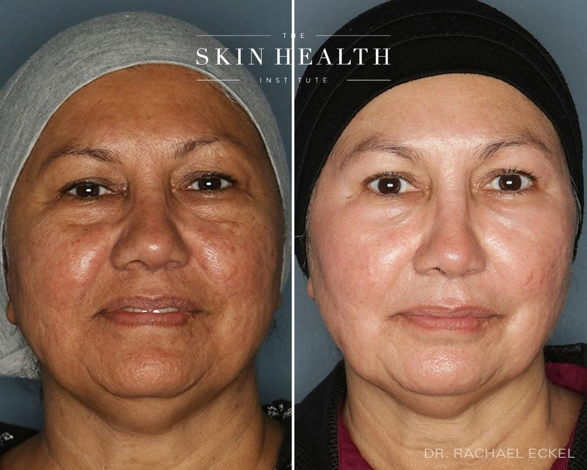 Before and After Results
