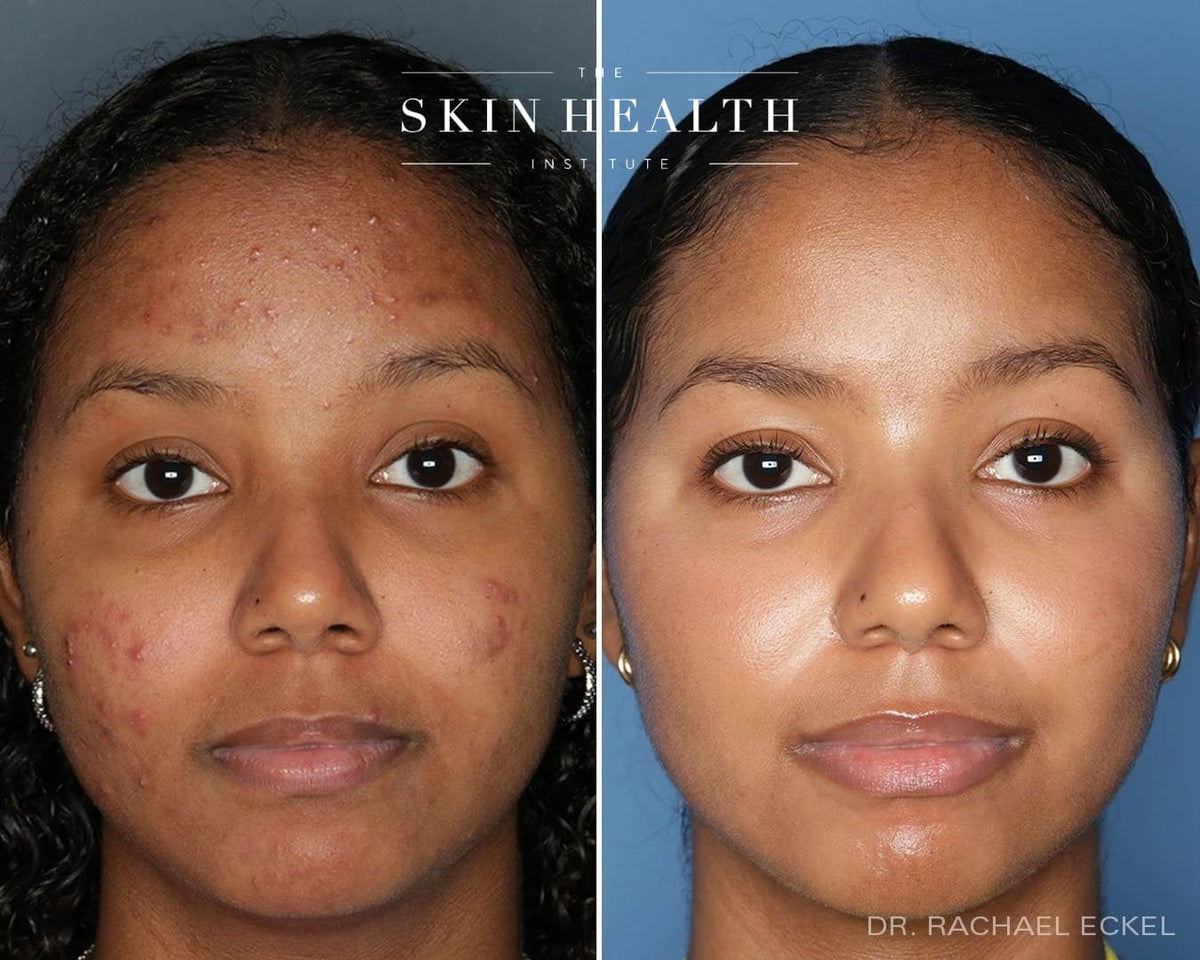 Before and After Results