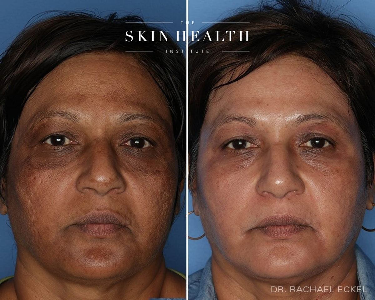 Before and After Results