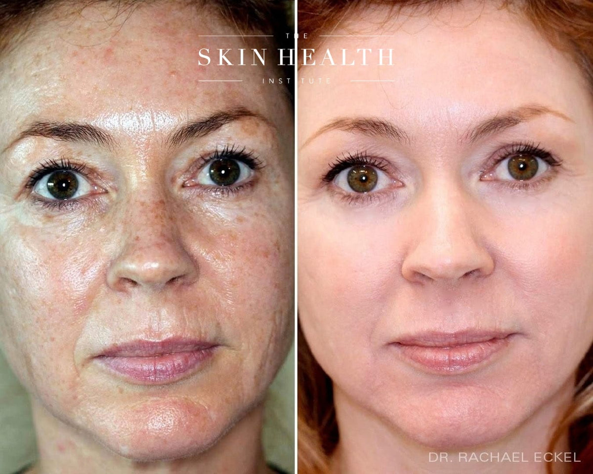 Before and After Results