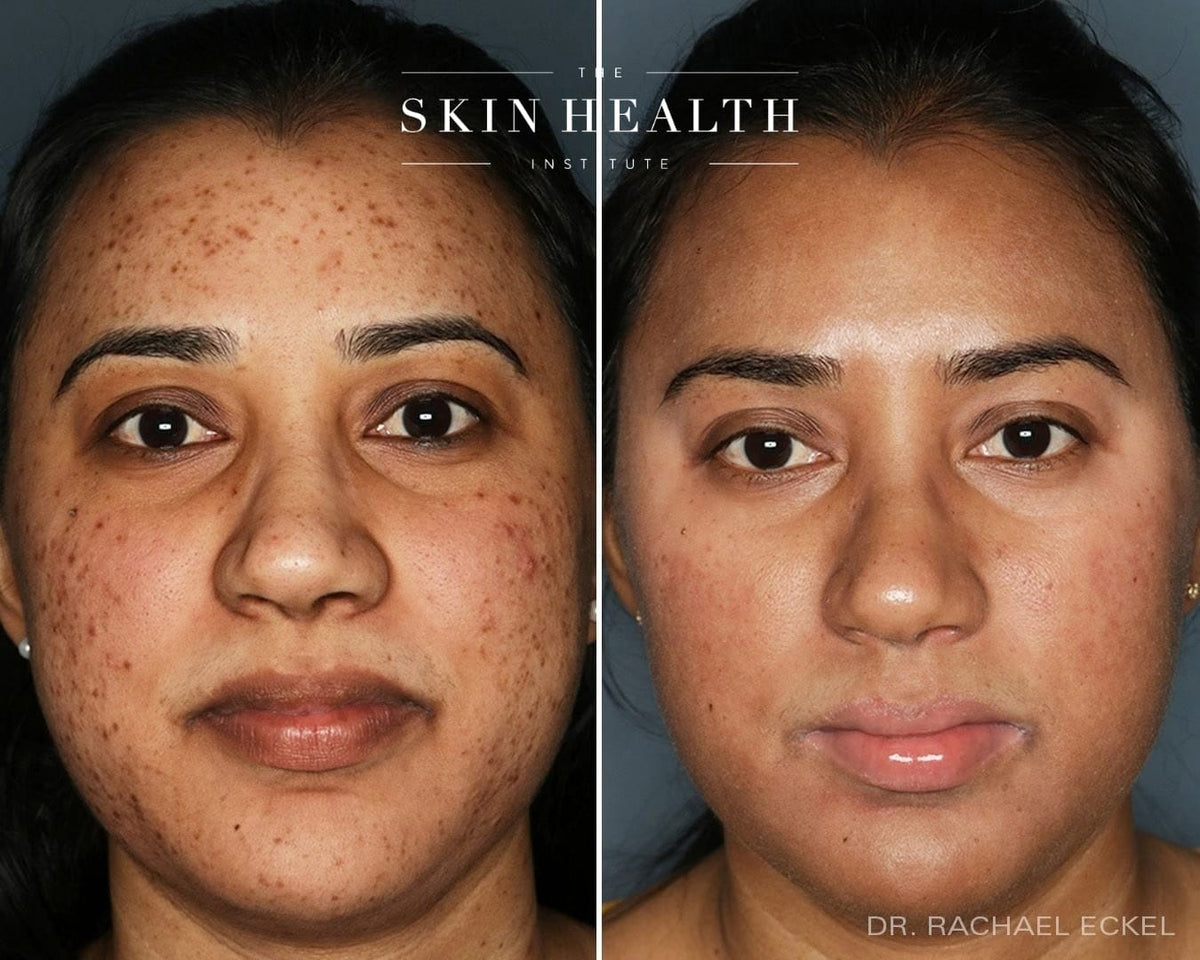 Before and After Results