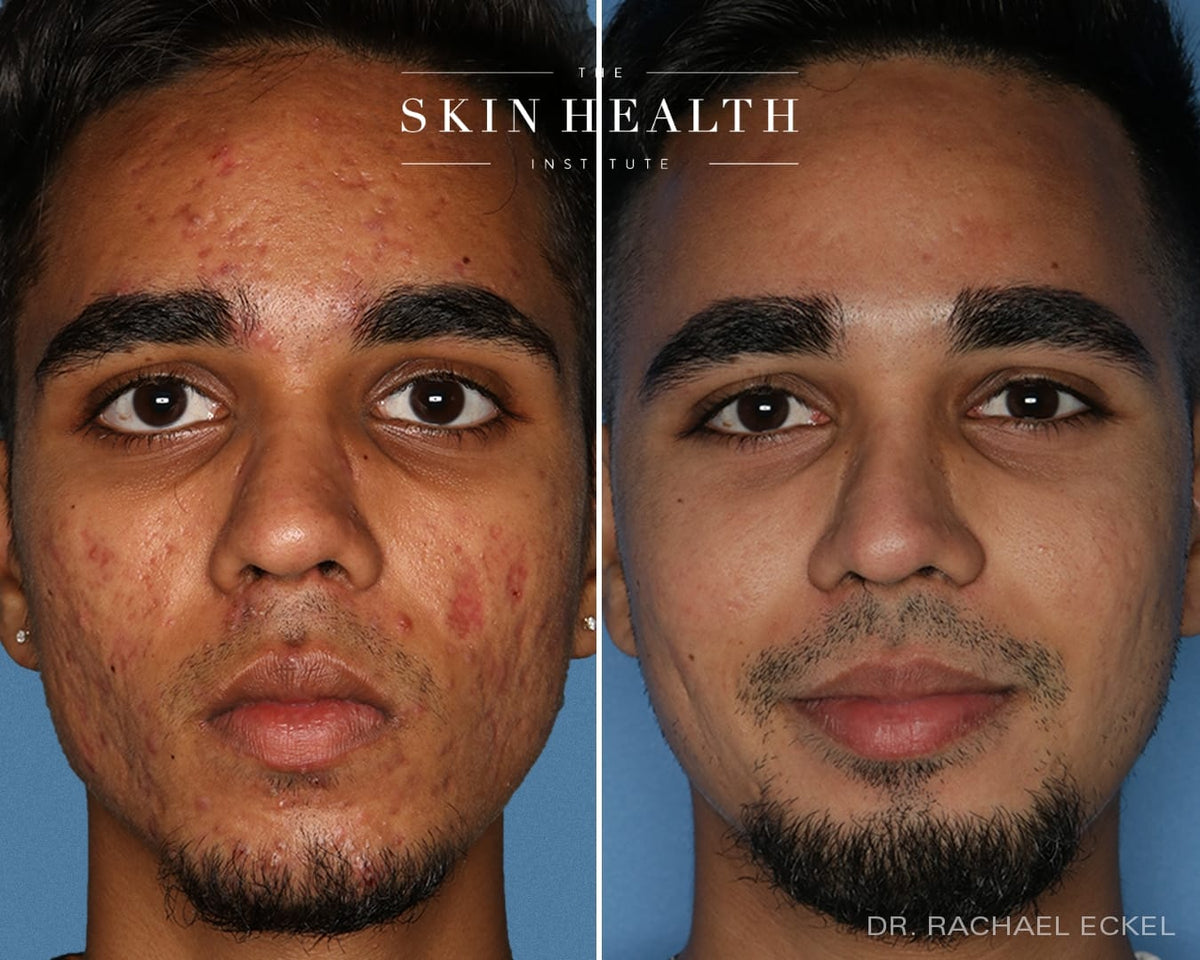 Before and After Results