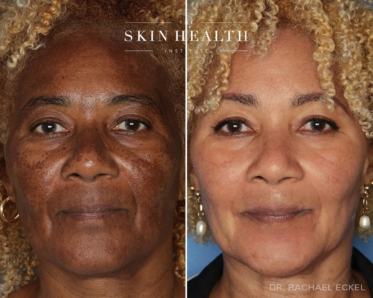Before and After Results