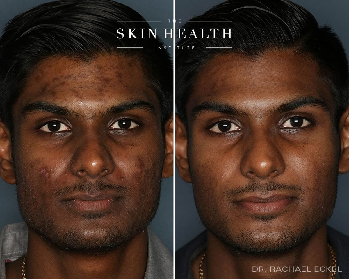 Before and After Results