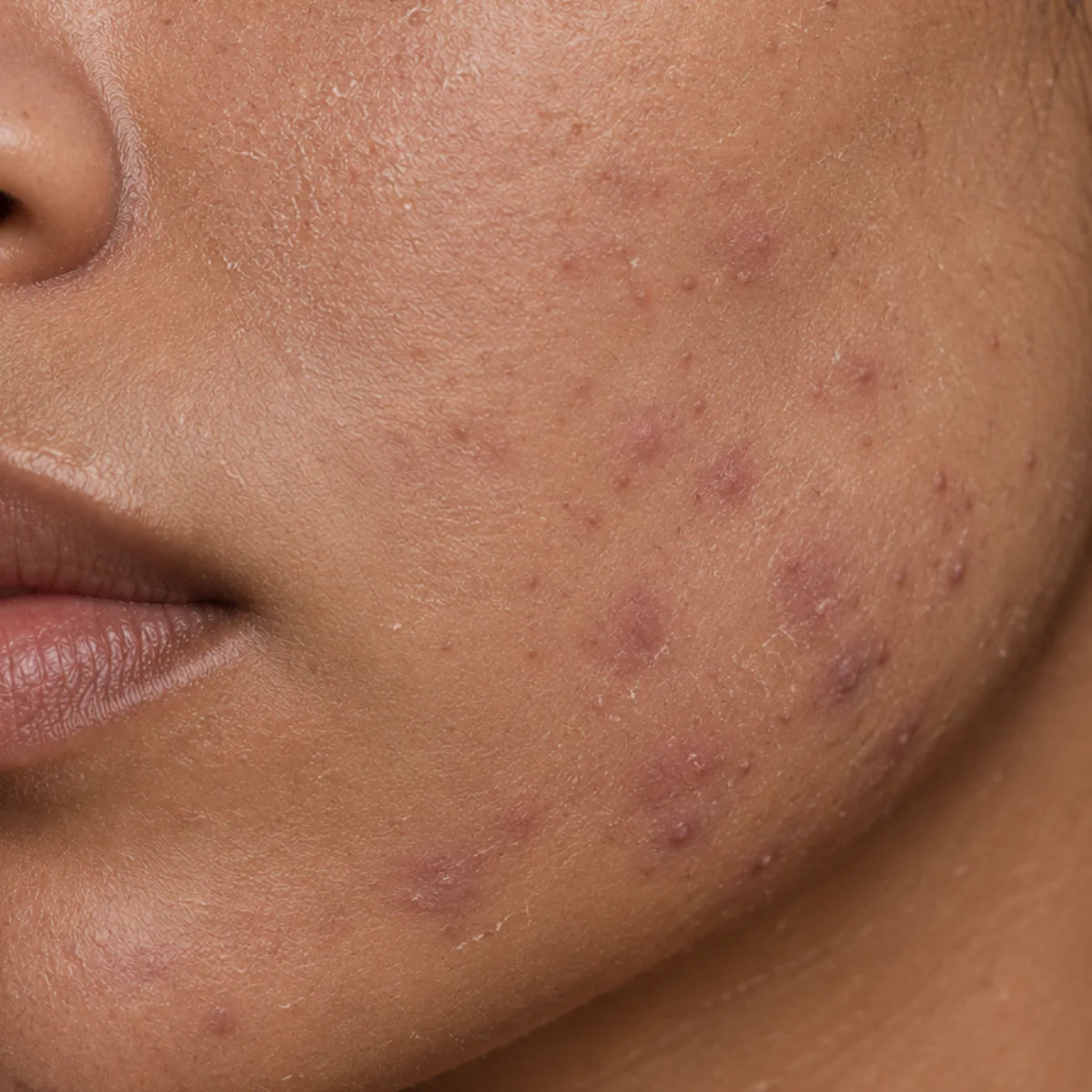 Acne